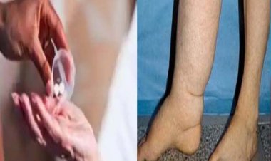 फाइलेरिया उन्मूलन के लिये 8 जिलों में चलेगा मॉस ड्रग एडमिनिस्ट्रेशन अभियान