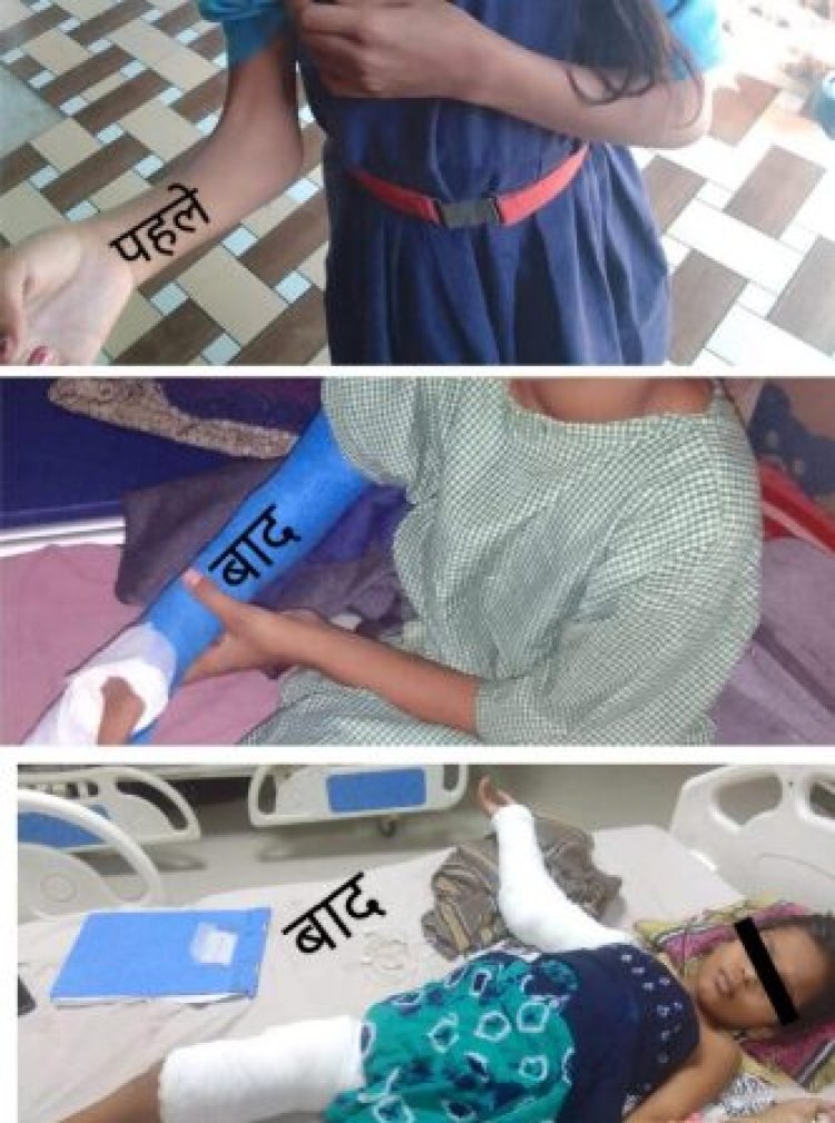अब सीमा भी सीधा कर पाएगी अपना हाथ निःशुल्क आपरेशन से सीधी हुई मुड़ी कोहनी