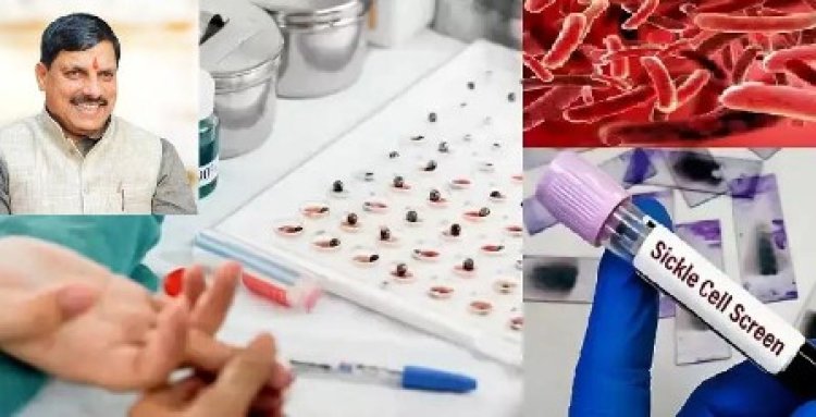 सिकल सेल मुक्त भारत अभियान में मध्यप्रदेश देश का अग्रणी राज्य