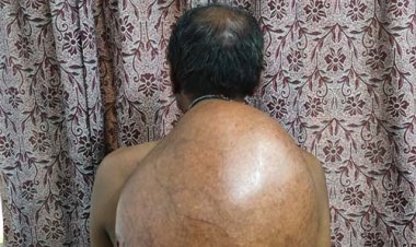 अम्बेडकर अस्पताल के सर्जरी विभाग की ऐतिहासिक उपलब्धि :10.30 किलोग्राम वजनी विशाल ट्यूमर का सफल ऑपरेशन