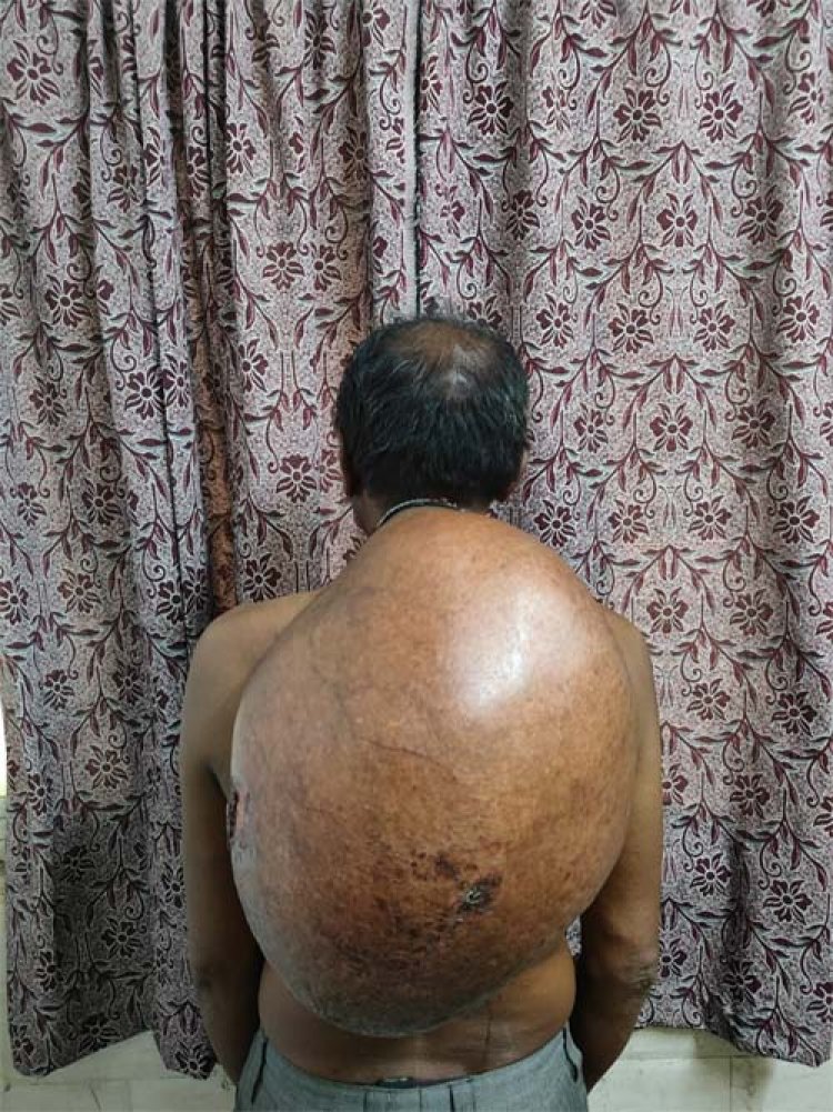 अम्बेडकर अस्पताल के सर्जरी विभाग की ऐतिहासिक उपलब्धि :10.30 किलोग्राम वजनी विशाल ट्यूमर का सफल ऑपरेशन